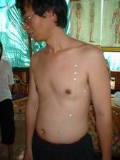 acupuncture meridian